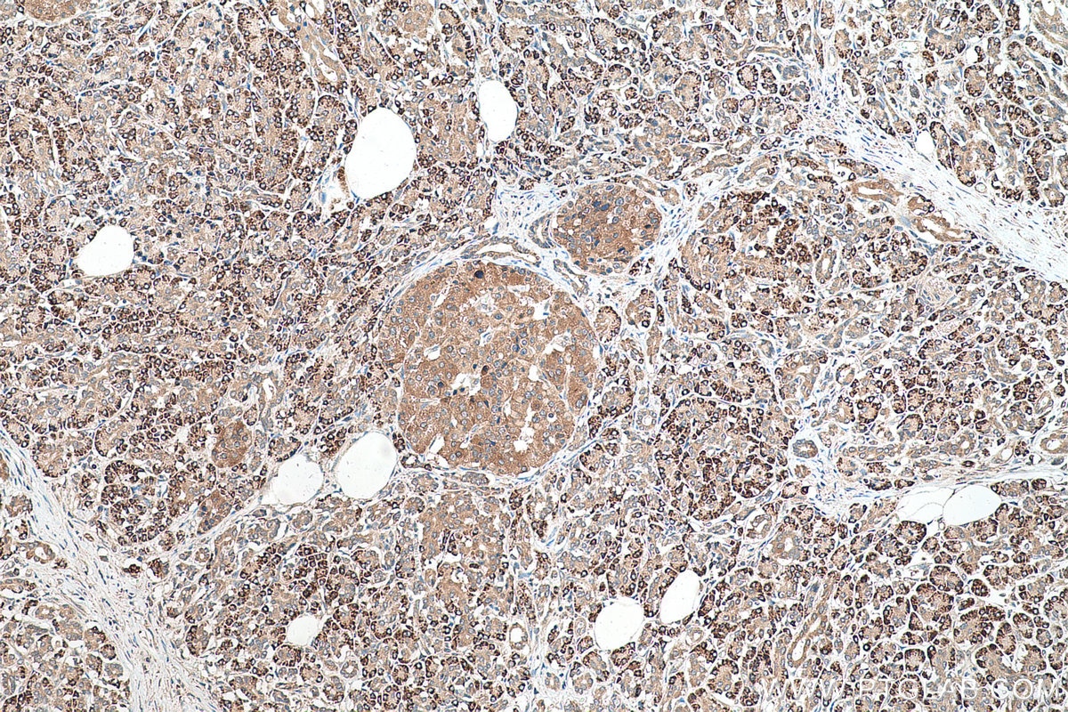 Immunohistochemical analysis of paraffin-embedded human pancreas cancer tissue slide using KHC0586 (RPL35 IHC Kit).