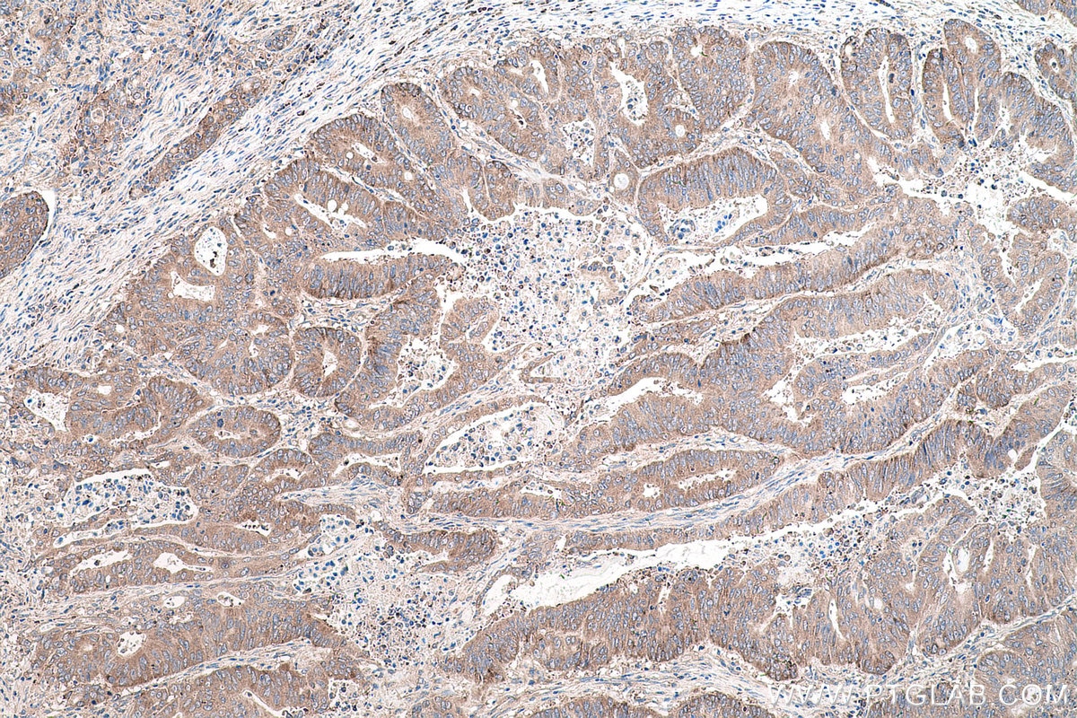 Immunohistochemical analysis of paraffin-embedded human colon cancer tissue slide using KHC0586 (RPL35 IHC Kit).