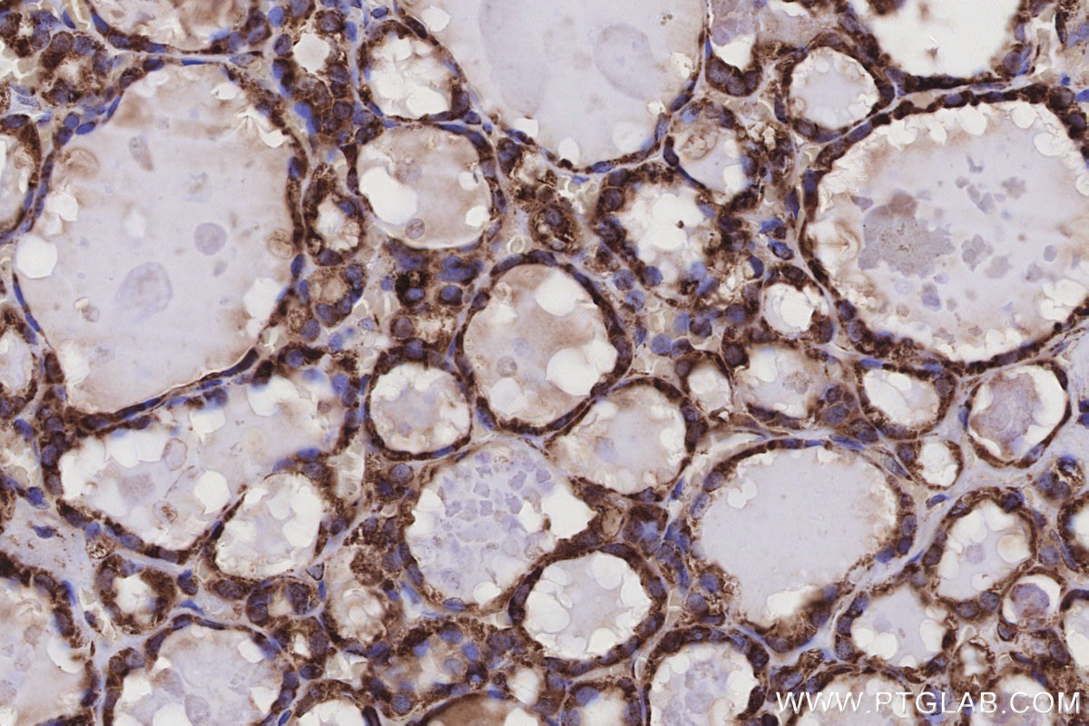 Immunohistochemical analysis of paraffin-embedded human thyroid cancer tissue slide using KHC3212 (RPL5 IHC Kit). Immunohistochemical analysis of paraffin-embedded human thyroid cancer tissue slide using KHC3212 (RPL5 IHC Kit).