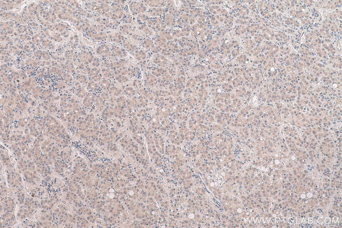 Immunohistochemical analysis of paraffin-embedded human liver cancer tissue slide using KHC0640 (RPL6 IHC Kit).