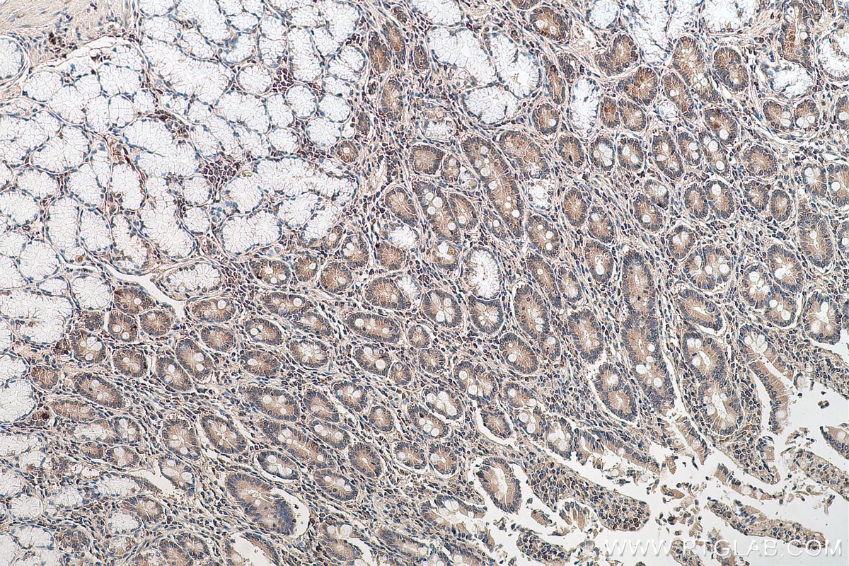Immunohistochemical analysis of paraffin-embedded human stomach cancer tissue slide using KHC0640 (RPL6 IHC Kit).