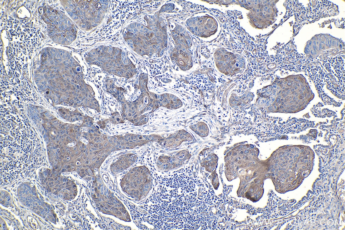 Immunohistochemical analysis of paraffin-embedded human lung cancer tissue slide using KHC1265 (RPL7A IHC Kit).