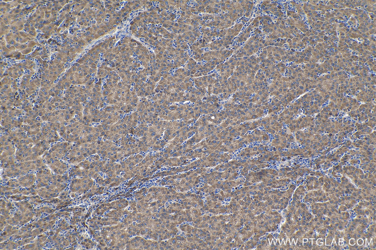 Immunohistochemical analysis of paraffin-embedded human liver cancer tissue slide using KHC1265 (RPL7A IHC Kit).