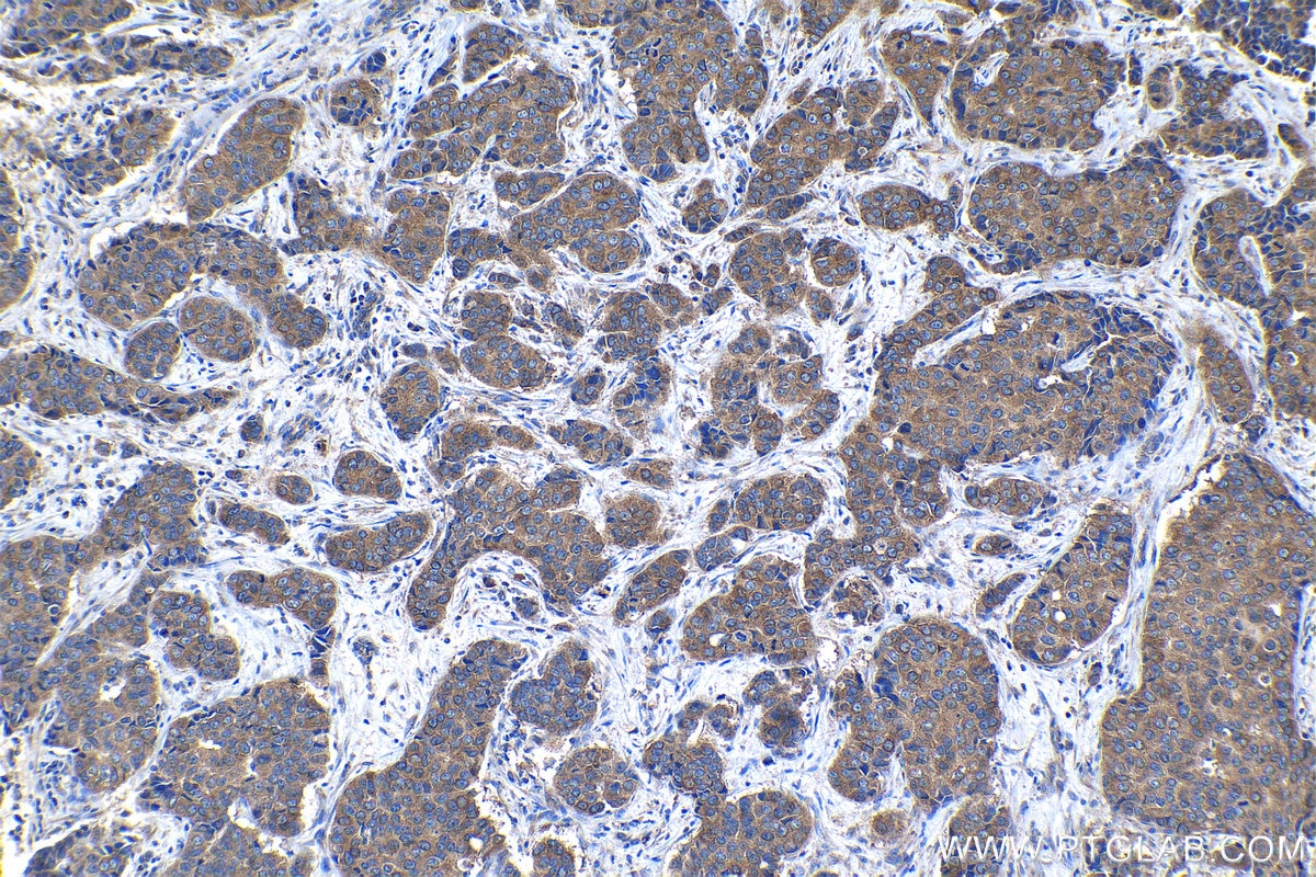 Immunohistochemical analysis of paraffin-embedded human breast cancer tissue slide using KHC1265 (RPL7A IHC Kit).