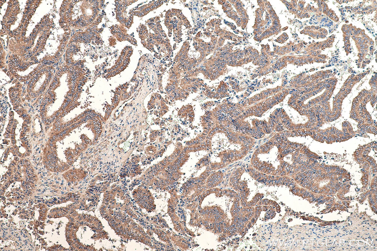 Immunohistochemical analysis of paraffin-embedded human ovary tumor tissue slide using KHC0831 (RPLP1 IHC Kit).
