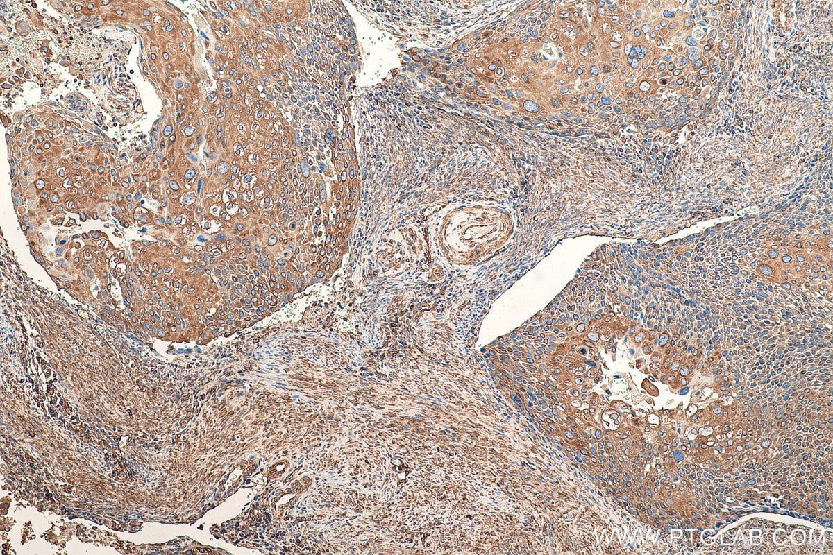 Immunohistochemical analysis of paraffin-embedded human cervical cancer tissue slide using KHC0831 (RPLP1 IHC Kit).