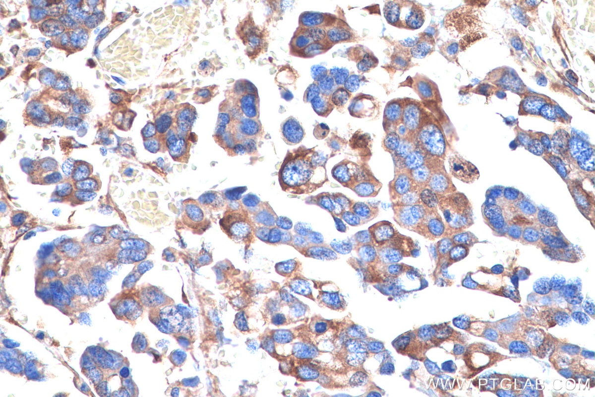 Immunohistochemical analysis of paraffin-embedded human colon cancer tissue slide using KHC0831 (RPLP1 IHC Kit).