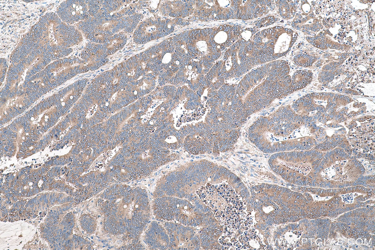 Immunohistochemical analysis of paraffin-embedded human colon cancer tissue slide using KHC0576 (RPLP2 IHC Kit).
