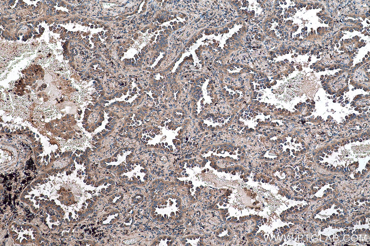 Immunohistochemical analysis of paraffin-embedded human lung cancer tissue slide using KHC0576 (RPLP2 IHC Kit).