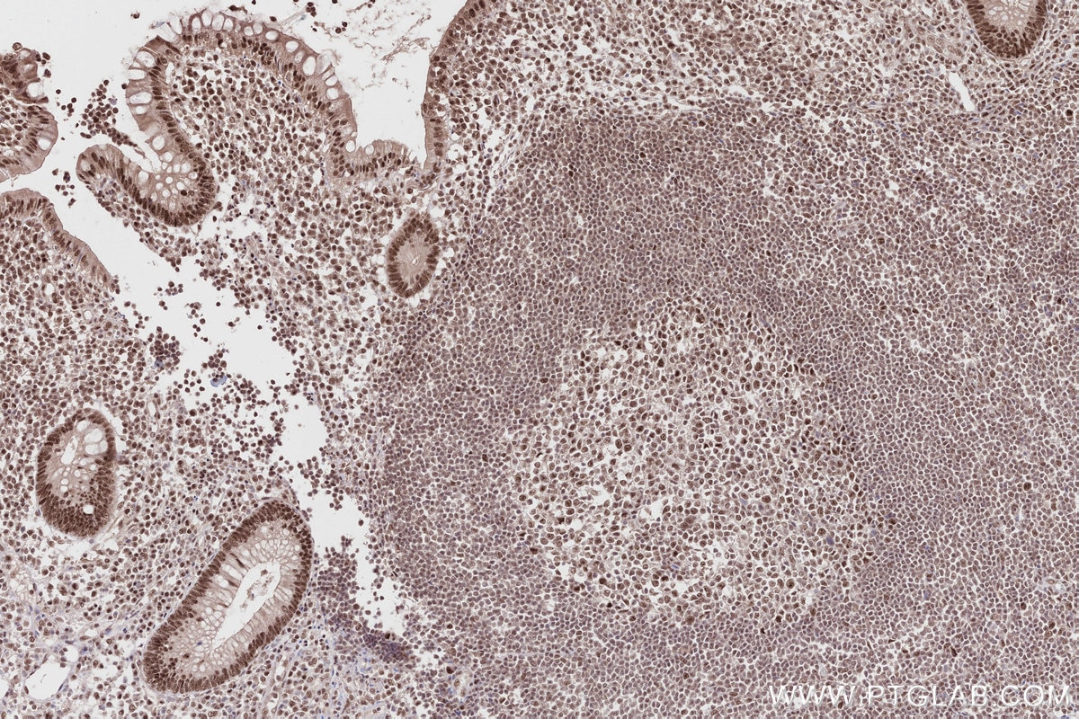 Immunohistochemical analysis of paraffin-embedded human appendicitis tissue slide using KHC2812 (RPRD1A/P15RS IHC Kit).