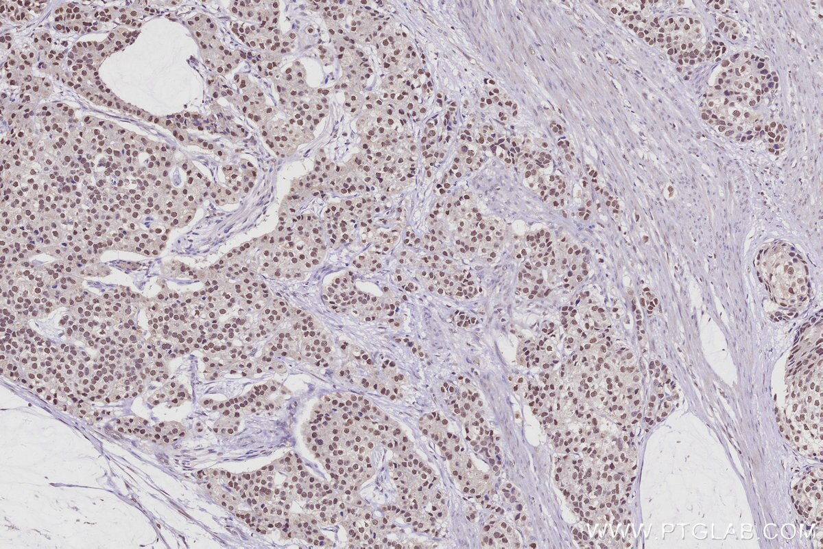 Immunohistochemical analysis of paraffin-embedded human stomach cancer tissue slide using KHC2941 (RPRD1B IHC Kit).
