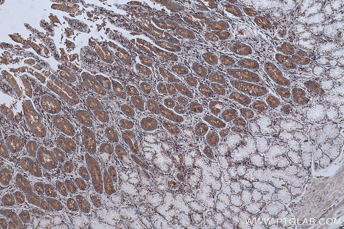 Immunohistochemical analysis of paraffin-embedded human stomach cancer tissue slide using KHC0641 (RPS13 IHC Kit).