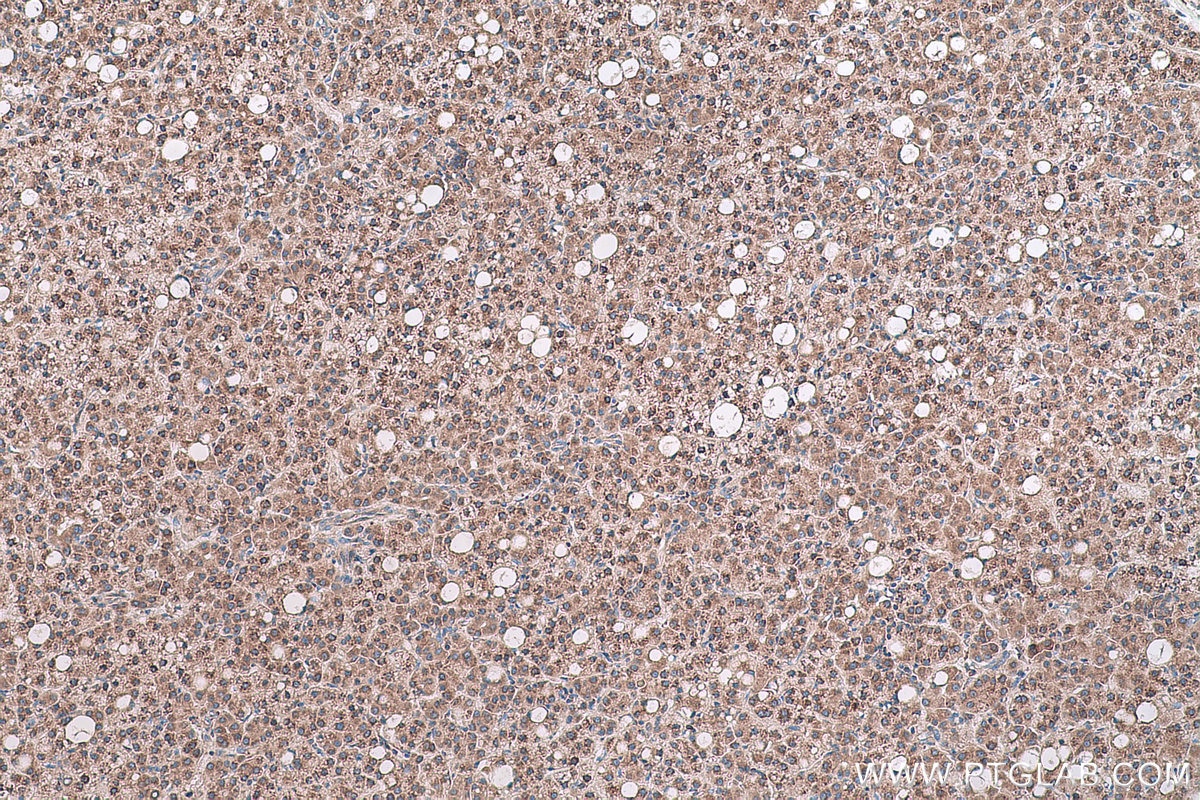 Immunohistochemical analysis of paraffin-embedded human liver cancer tissue slide using KHC0641 (RPS13 IHC Kit).