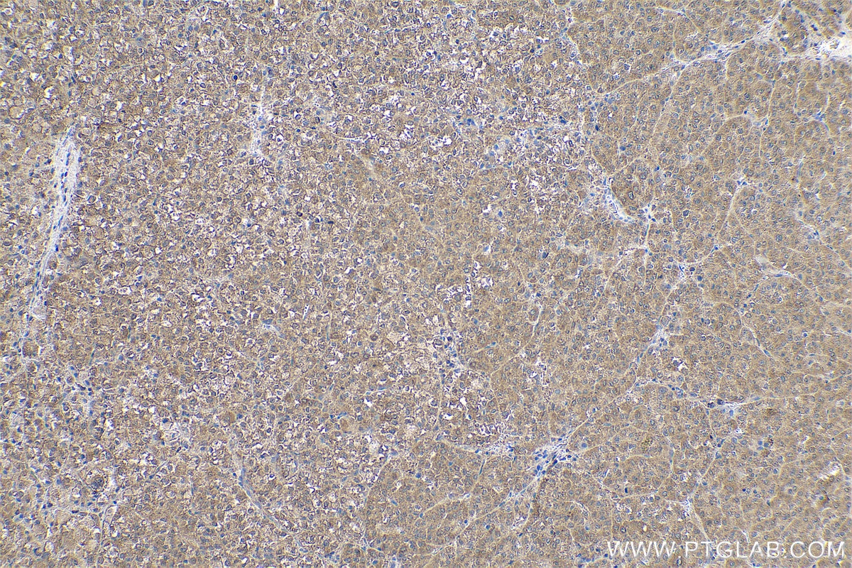 Immunohistochemical analysis of paraffin-embedded human liver cancer tissue slide using KHC0595 (RPS14 IHC Kit).