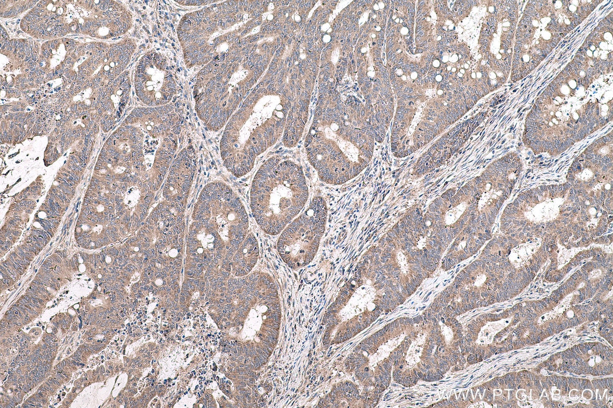 Immunohistochemical analysis of paraffin-embedded human colon cancer tissue slide using KHC0595 (RPS14 IHC Kit).