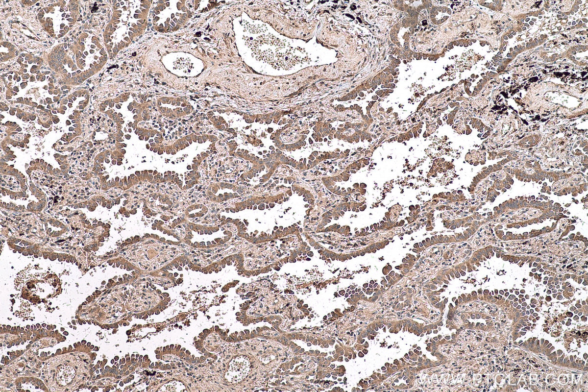 Immunohistochemical analysis of paraffin-embedded human lung cancer tissue slide using KHC0595 (RPS14 IHC Kit).
