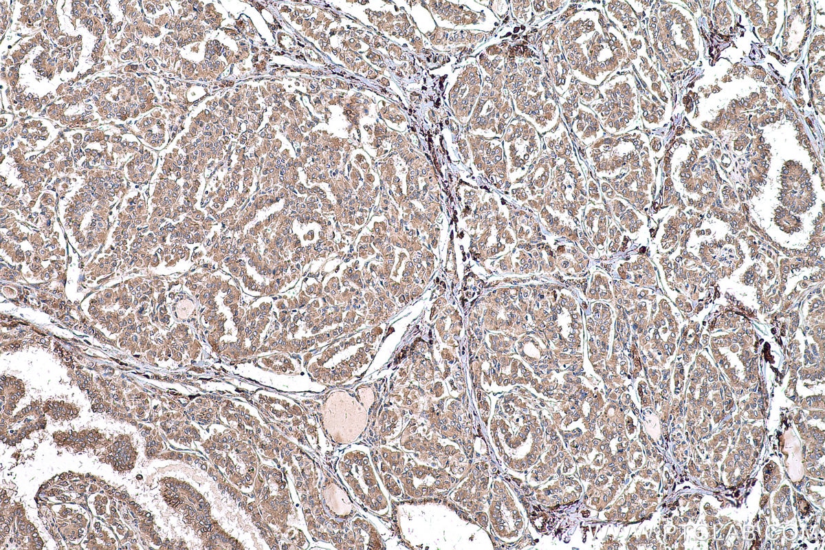 Immunohistochemical analysis of paraffin-embedded human thyroid cancer tissue slide using KHC0595 (RPS14 IHC Kit).