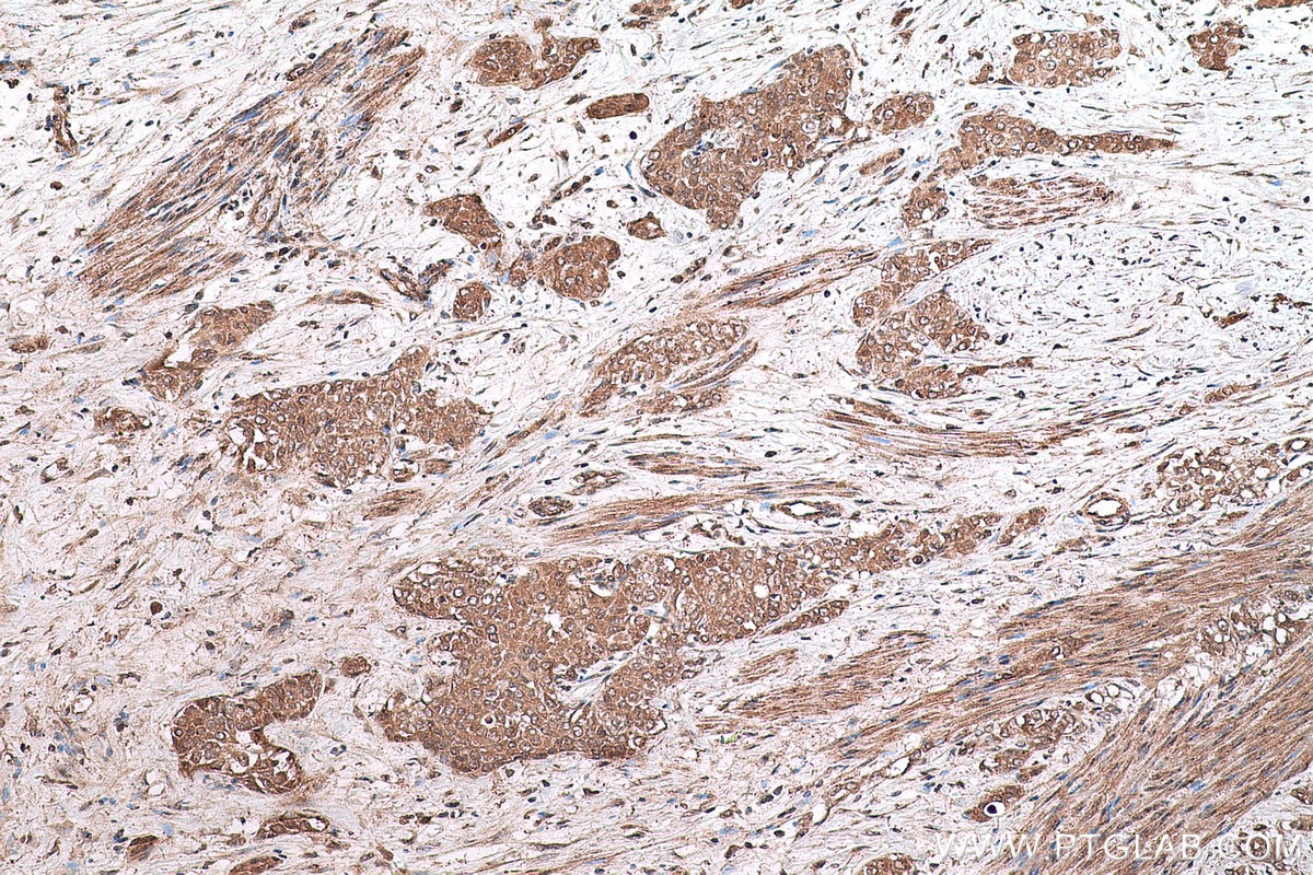 Immunohistochemical analysis of paraffin-embedded human urothelial carcinoma tissue slide using KHC0595 (RPS14 IHC Kit).