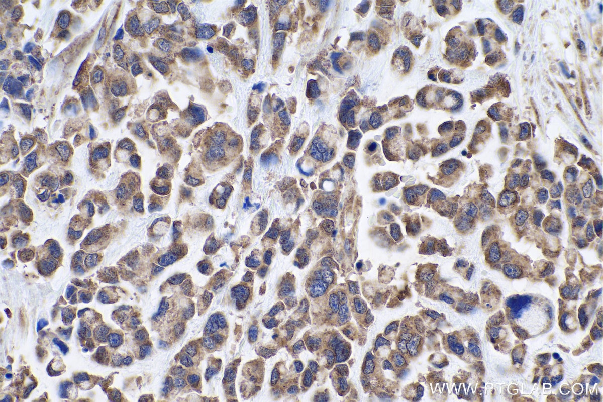 Immunohistochemical analysis of paraffin-embedded human colon cancer tissue slide using KHC0930 (RPS15 IHC Kit).