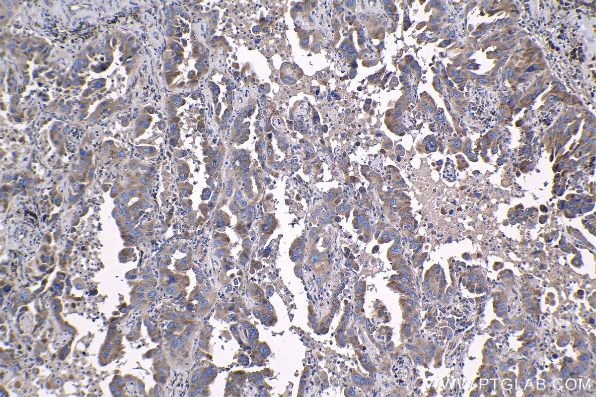 Immunohistochemical analysis of paraffin-embedded human lung cancer tissue slide using KHC1188 (RPS20 IHC Kit).