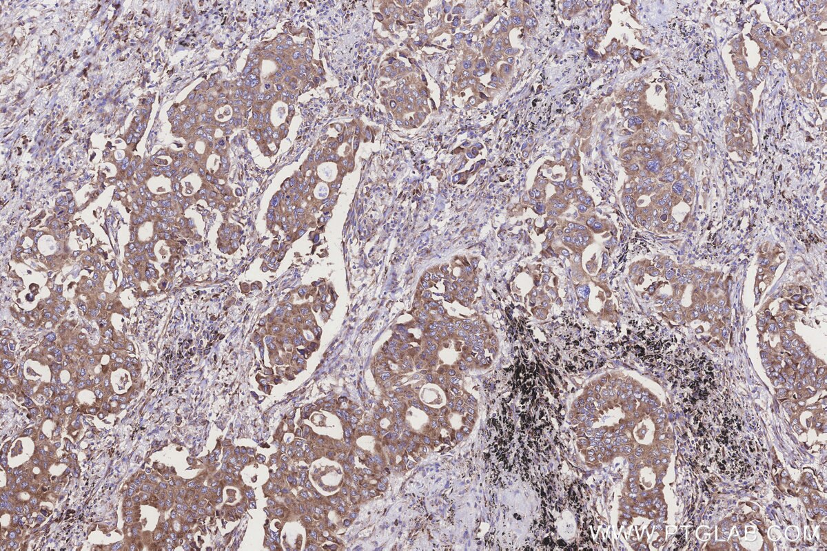 Immunohistochemical analysis of paraffin-embedded human lung cancer tissue slide using KHC3243 (RPS23 IHC Kit). Immunohistochemical analysis of paraffin-embedded human lung cancer tissue slide using KHC3243 (RPS23 IHC Kit).