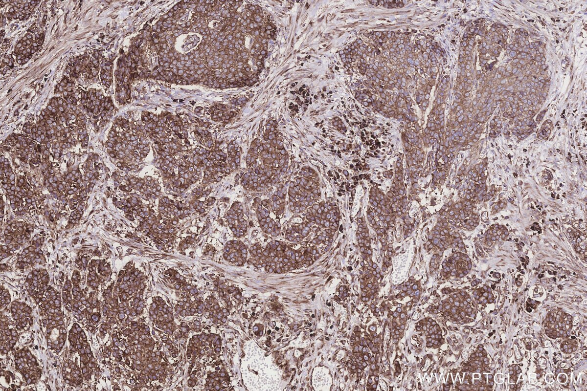 Immunohistochemical analysis of paraffin-embedded human stomach cancer tissue slide using KHC3243 (RPS23 IHC Kit). Immunohistochemical analysis of paraffin-embedded human stomach cancer tissue slide using KHC3243 (RPS23 IHC Kit).