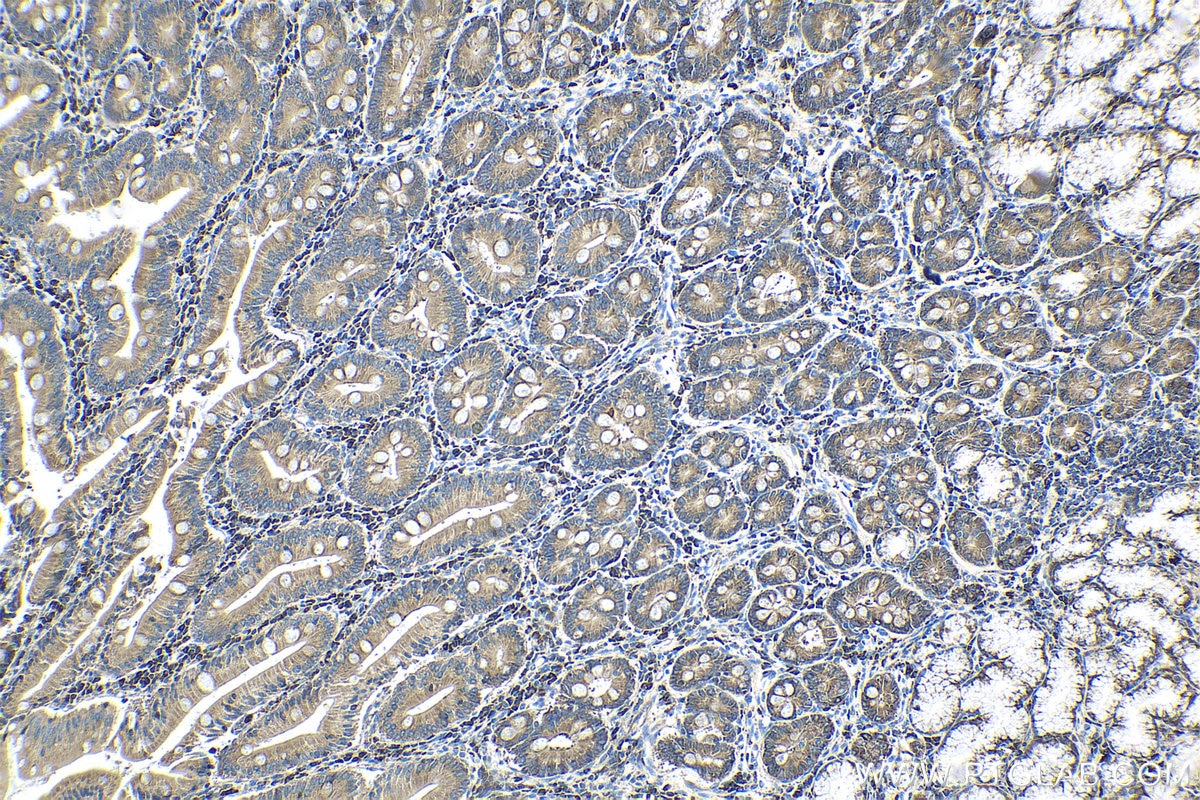 Immunohistochemical analysis of paraffin-embedded human stomach cancer tissue slide using KHC1560 (RPS3 IHC Kit).