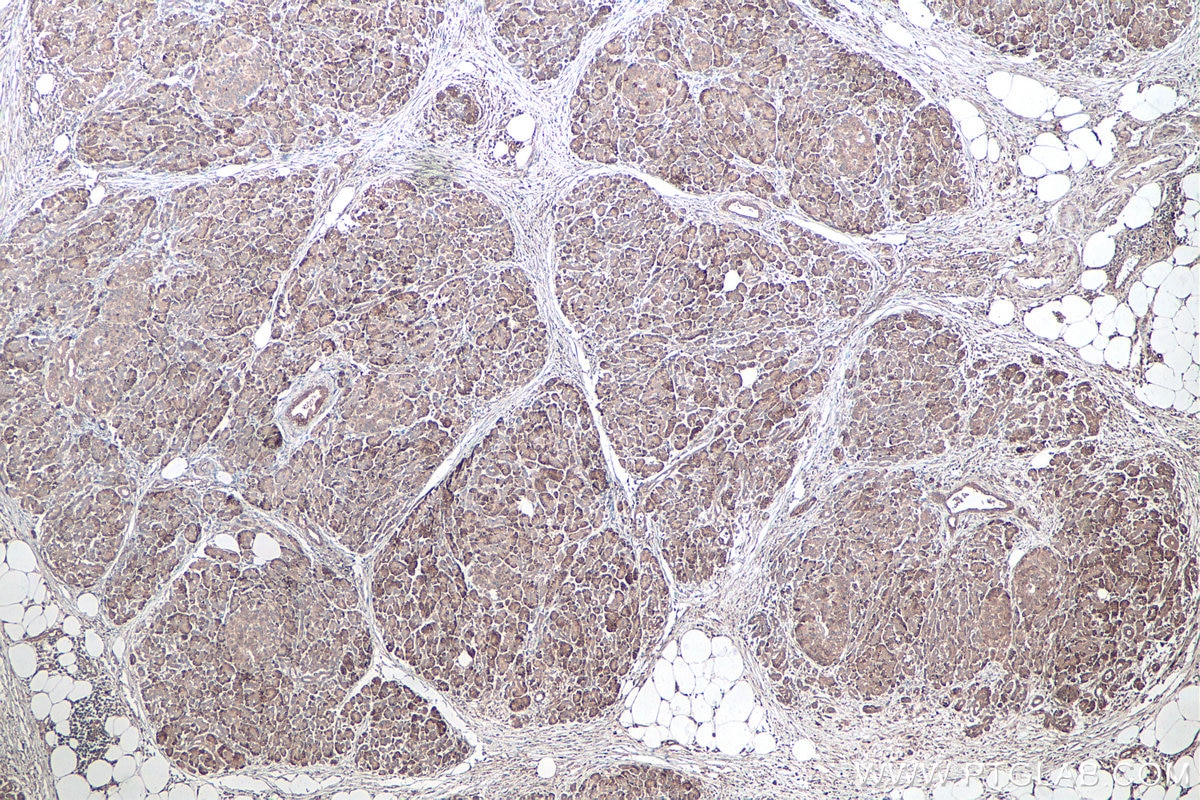 Immunohistochemical analysis of paraffin-embedded human pancreas cancer tissue slide using KHC0889 (RPS3A IHC Kit).