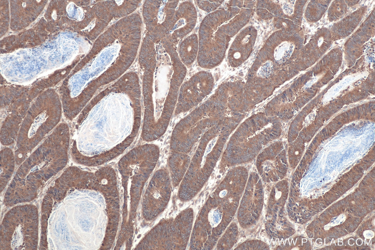 Immunohistochemical analysis of paraffin-embedded human colon cancer tissue slide using KHC0889 (RPS3A IHC Kit).