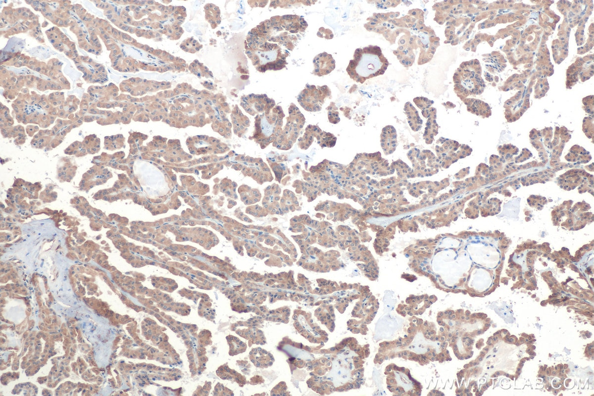 Immunohistochemical analysis of paraffin-embedded human thyroid cancer tissue slide using KHC0889 (RPS3A IHC Kit).