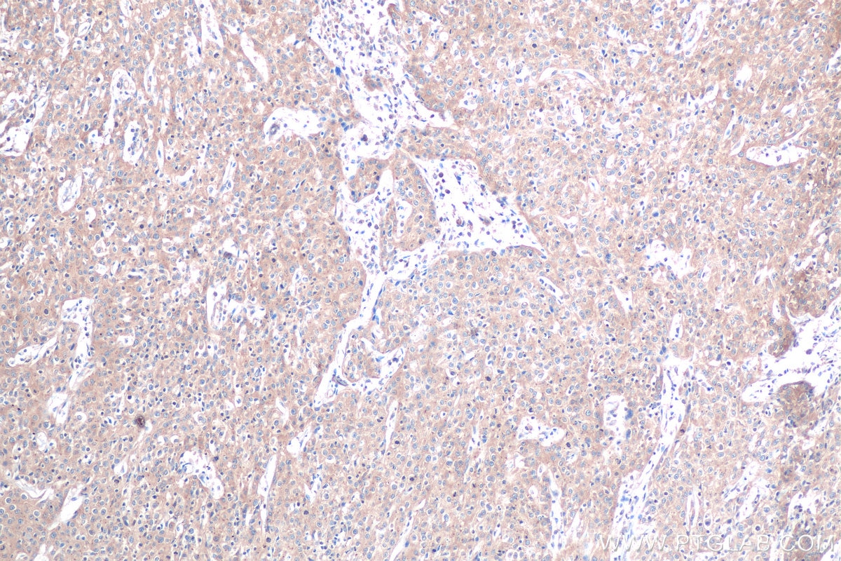 Immunohistochemical analysis of paraffin-embedded human cervical cancer tissue slide using KHC0889 (RPS3A IHC Kit).