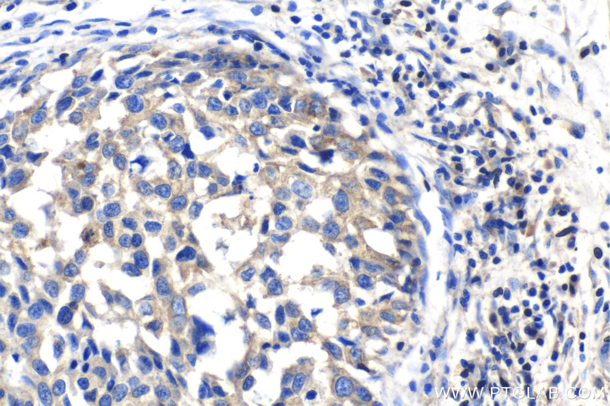 Immunohistochemical analysis of paraffin-embedded human breast cancer tissue slide using KHC1409 (RPS4X IHC Kit).