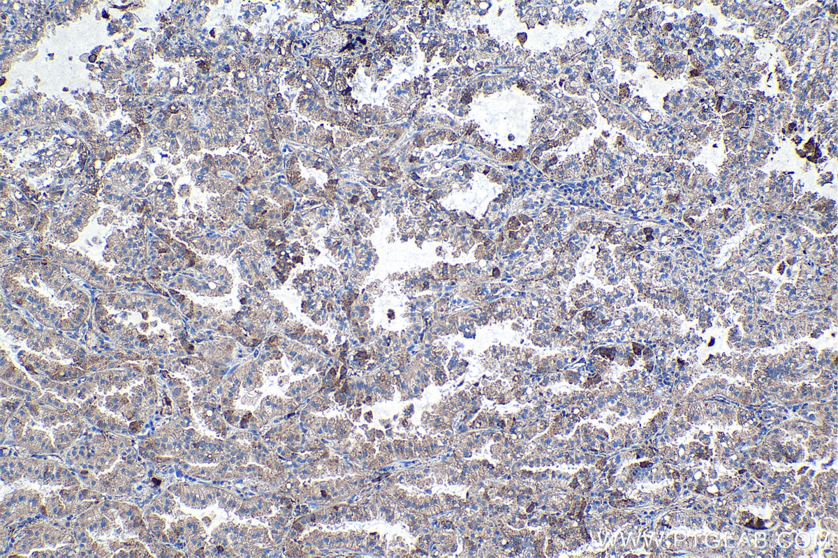 Immunohistochemical analysis of paraffin-embedded human lung cancer tissue slide using KHC1146 (RPS5 IHC Kit).