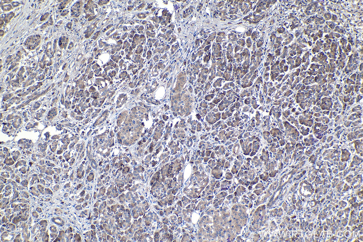 Immunohistochemical analysis of paraffin-embedded human pancreas cancer tissue slide using KHC1146 (RPS5 IHC Kit).
