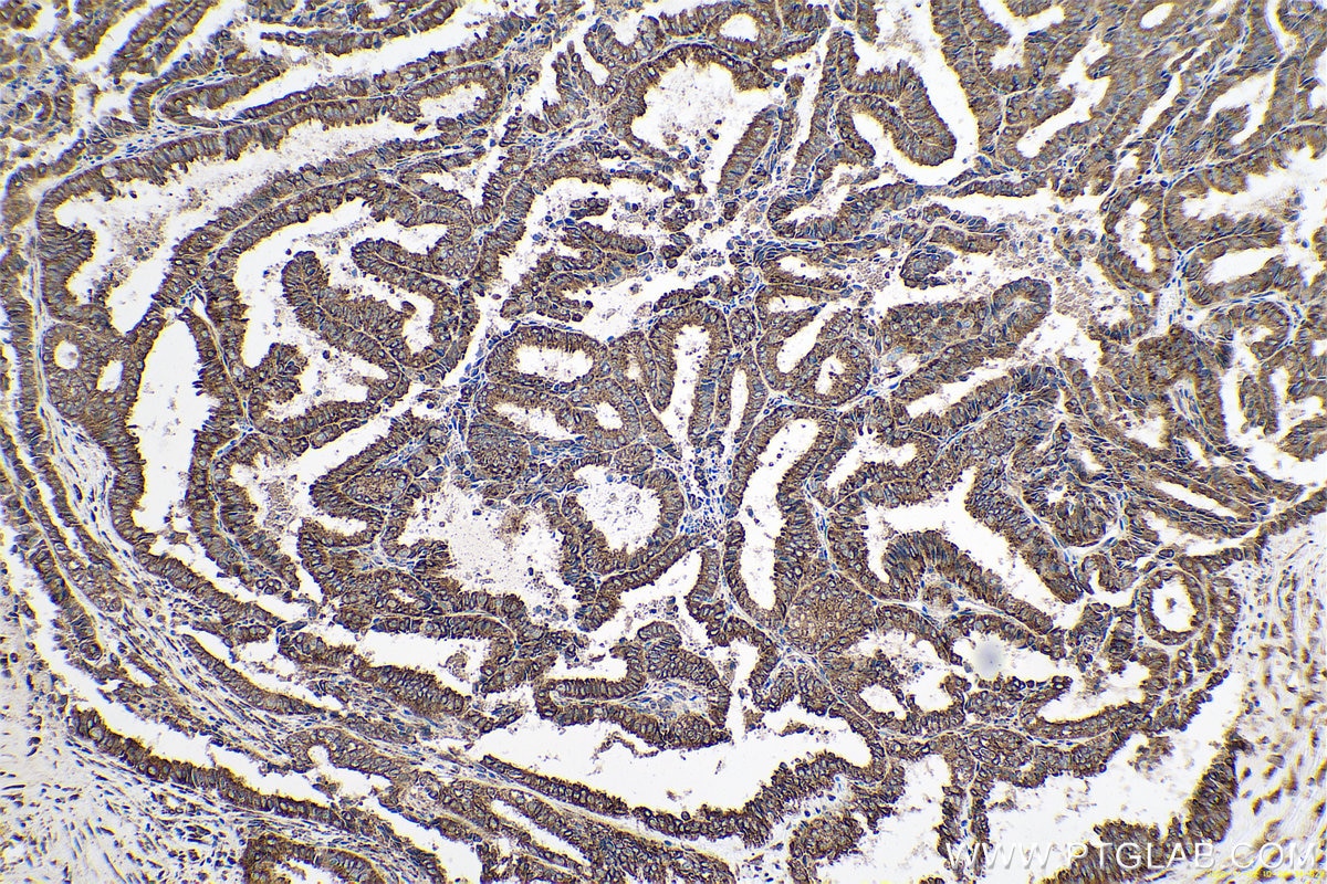 Immunohistochemical analysis of paraffin-embedded human ovary tumor tissue slide using KHC0662 (RRBP1 IHC Kit).
