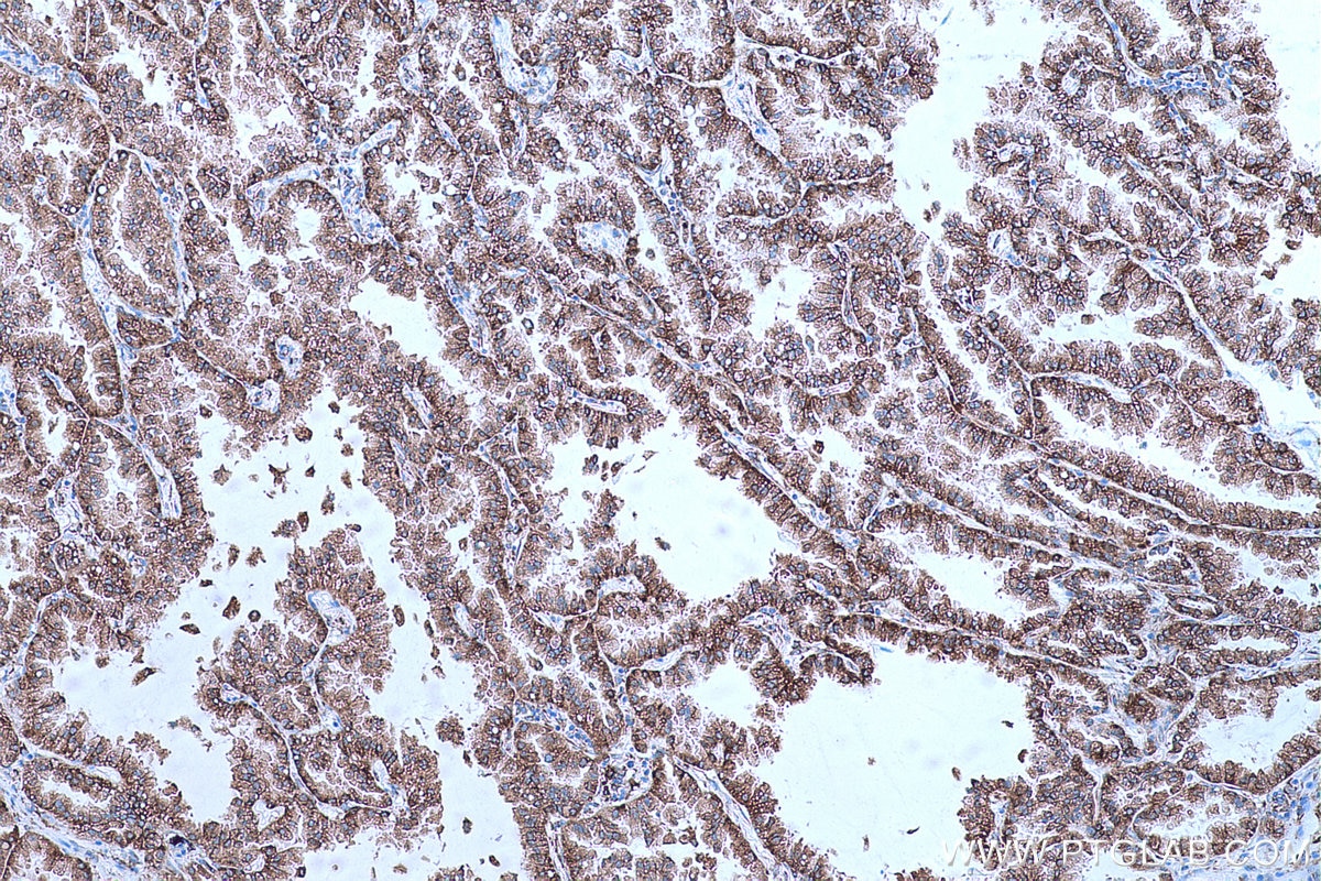 Immunohistochemical analysis of paraffin-embedded human lung cancer tissue slide using KHC0662 (RRBP1 IHC Kit).