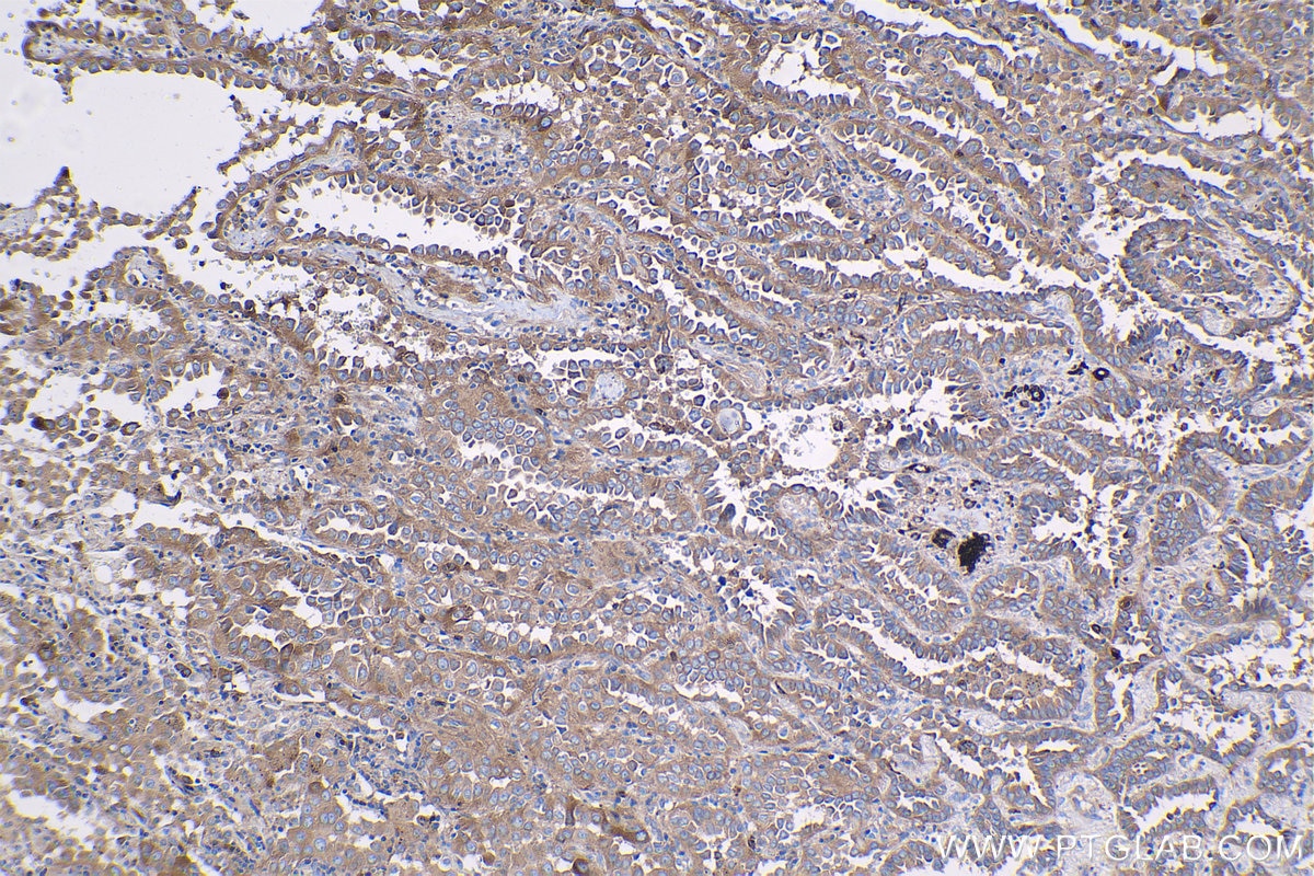 Immunohistochemical analysis of paraffin-embedded human lung cancer tissue slide using KHC1330 (RRM1 IHC Kit).