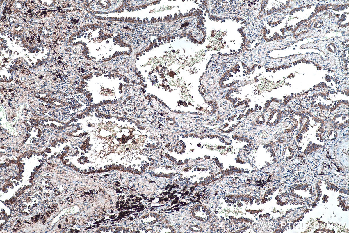 Immunohistochemical analysis of paraffin-embedded human lung cancer tissue slide using KHC0455 (RSU1 IHC Kit).