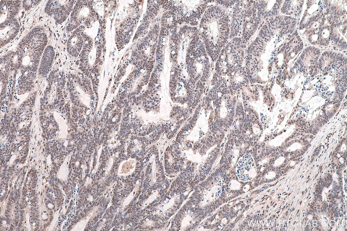 Immunohistochemical analysis of paraffin-embedded human colon cancer tissue slide using KHC0860 (RTCB IHC Kit).