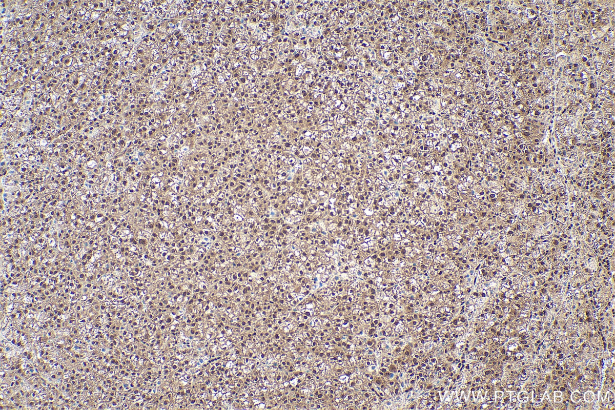 Immunohistochemical analysis of paraffin-embedded human liver cancer tissue slide using KHC0860 (RTCB IHC Kit).