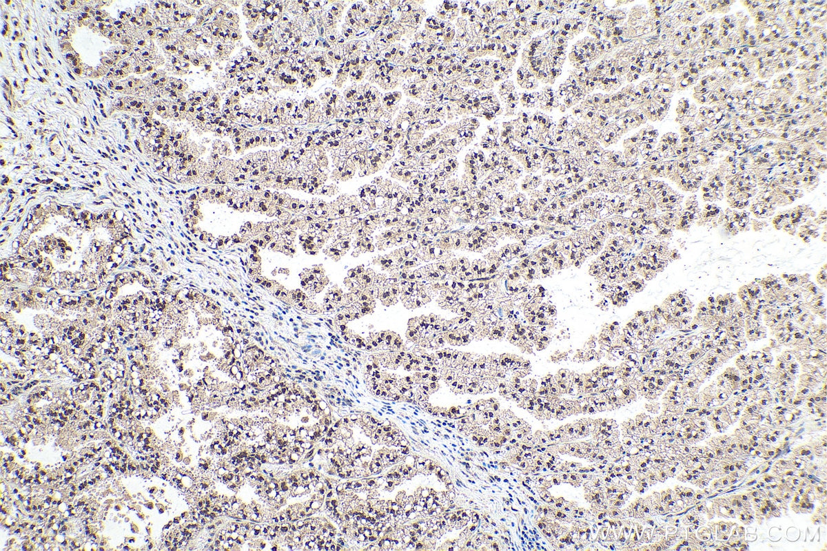 Immunohistochemical analysis of paraffin-embedded human lung cancer tissue slide using KHC0899 (RTRAF/C14orf166 IHC Kit).