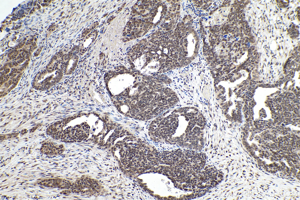 Immunohistochemical analysis of paraffin-embedded human ovary tumor tissue slide using KHC0899 (RTRAF/C14orf166 IHC Kit).