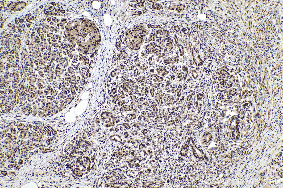 Immunohistochemical analysis of paraffin-embedded human pancreas cancer tissue slide using KHC0899 (RTRAF/C14orf166 IHC Kit).