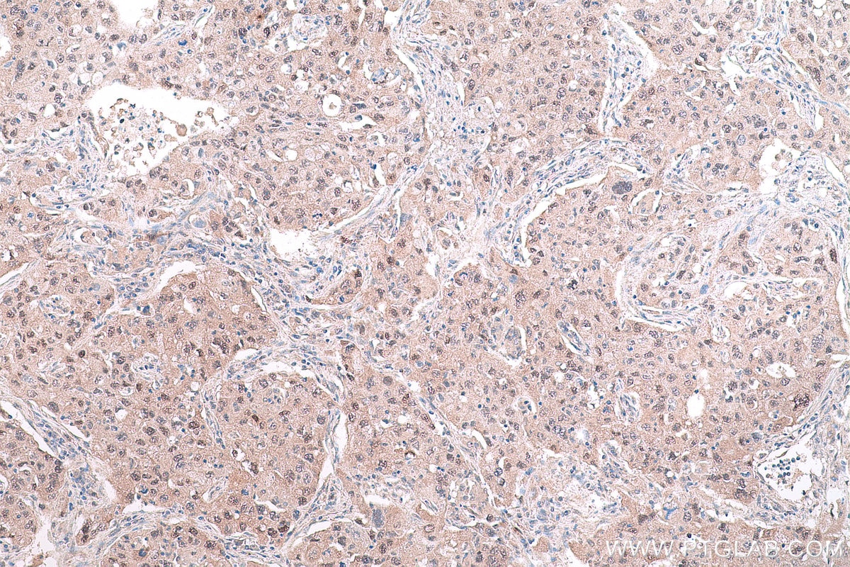 Immunohistochemical analysis of paraffin-embedded human lung cancer tissue slide using KHC0828 (RUVBL1 IHC Kit).