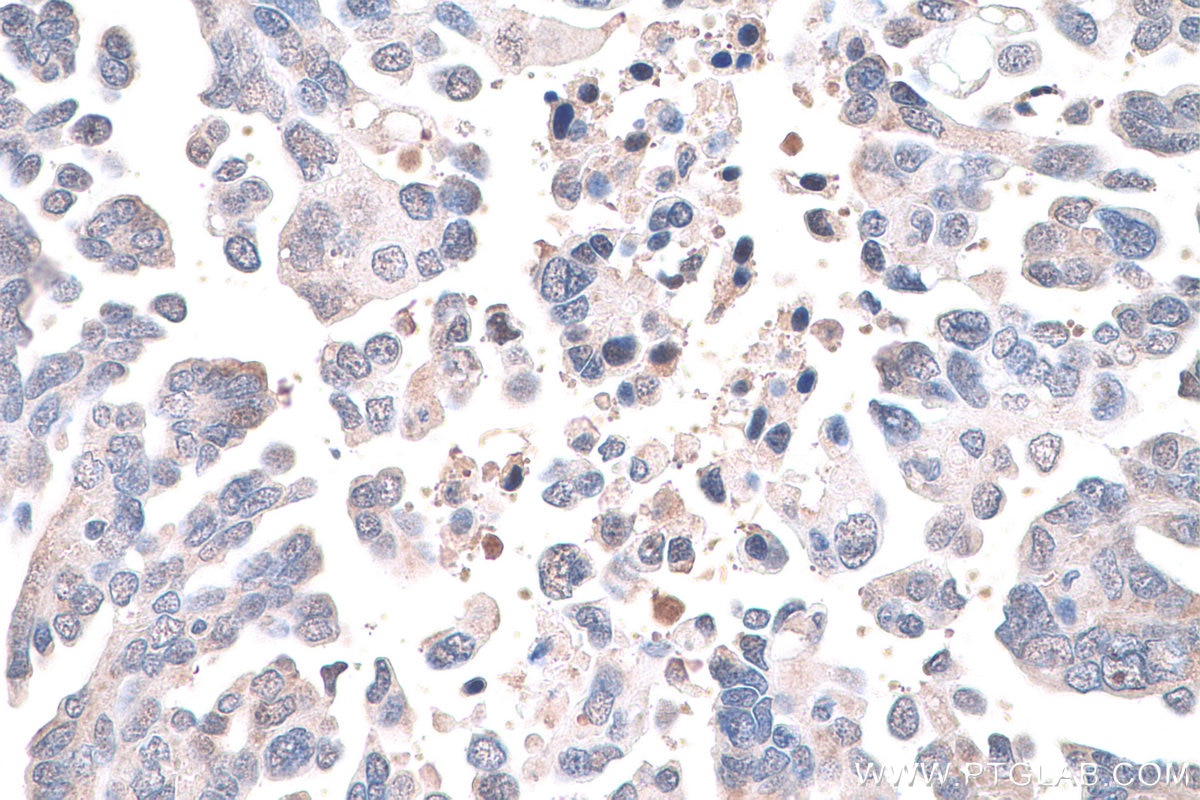 Immunohistochemical analysis of paraffin-embedded human colon cancer tissue slide using KHC0828 (RUVBL1 IHC Kit).