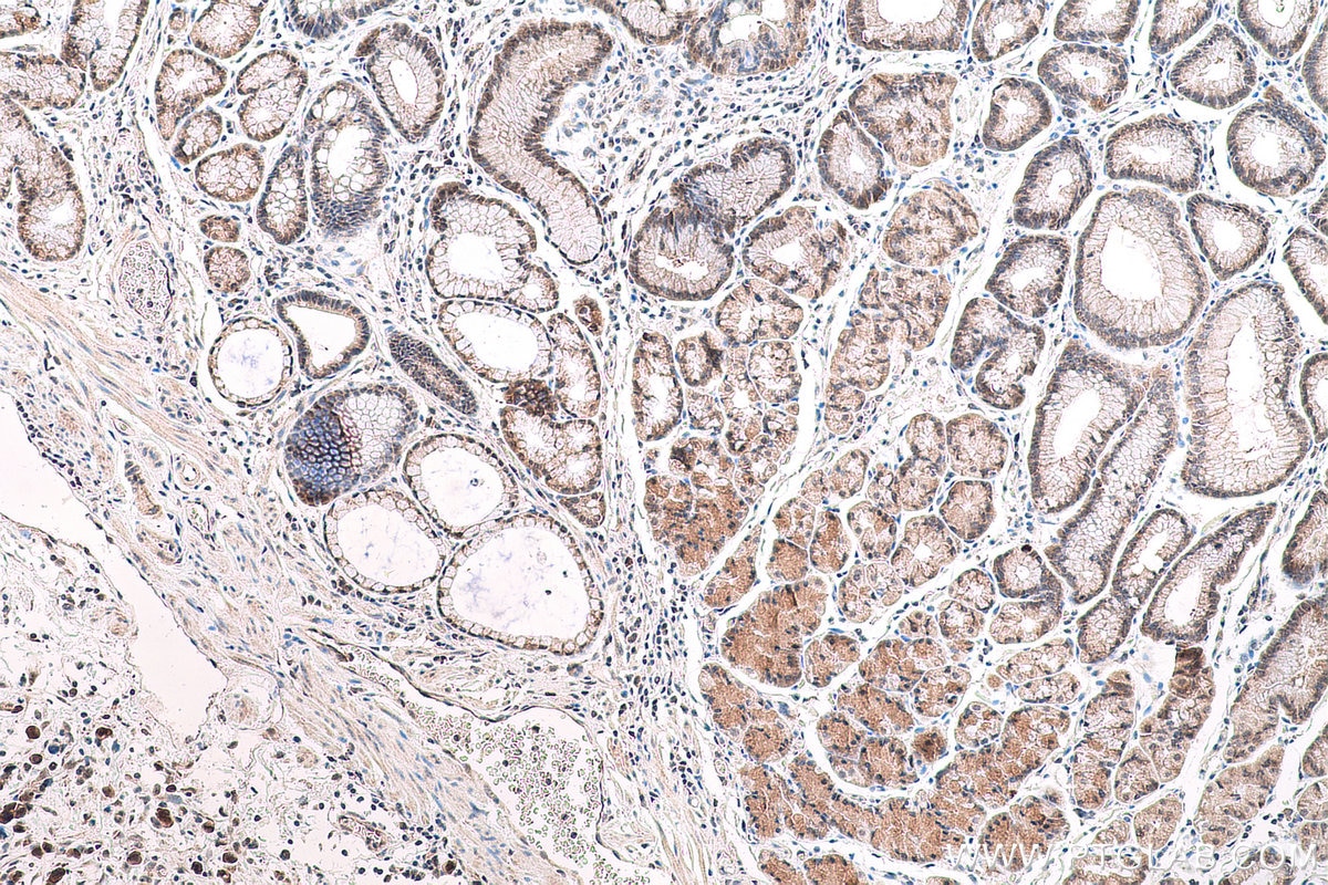 Immunohistochemical analysis of paraffin-embedded human stomach cancer tissue slide using KHC0828 (RUVBL1 IHC Kit).