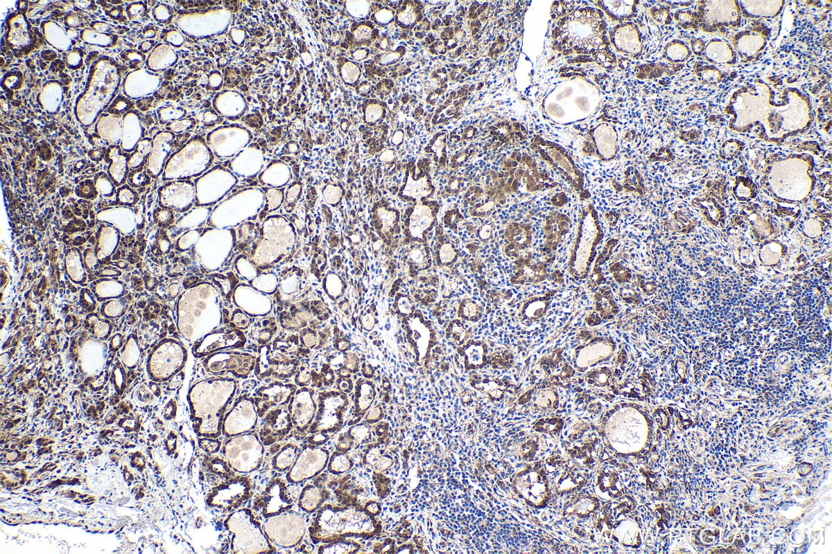 Immunohistochemical analysis of paraffin-embedded human thyroid cancer tissue slide using KHC1603 (RXRA IHC Kit).