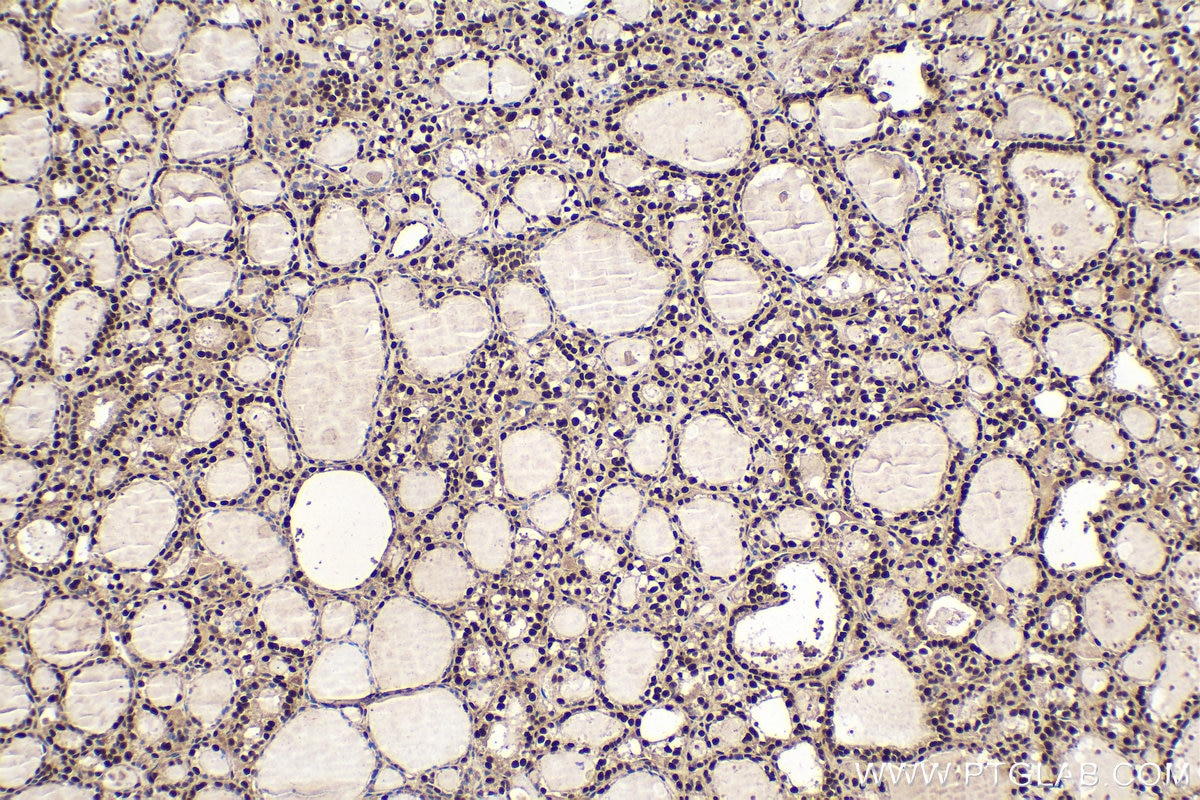 Immunohistochemical analysis of paraffin-embedded human thyroid cancer tissue slide using KHC1575 (RXRB IHC Kit).