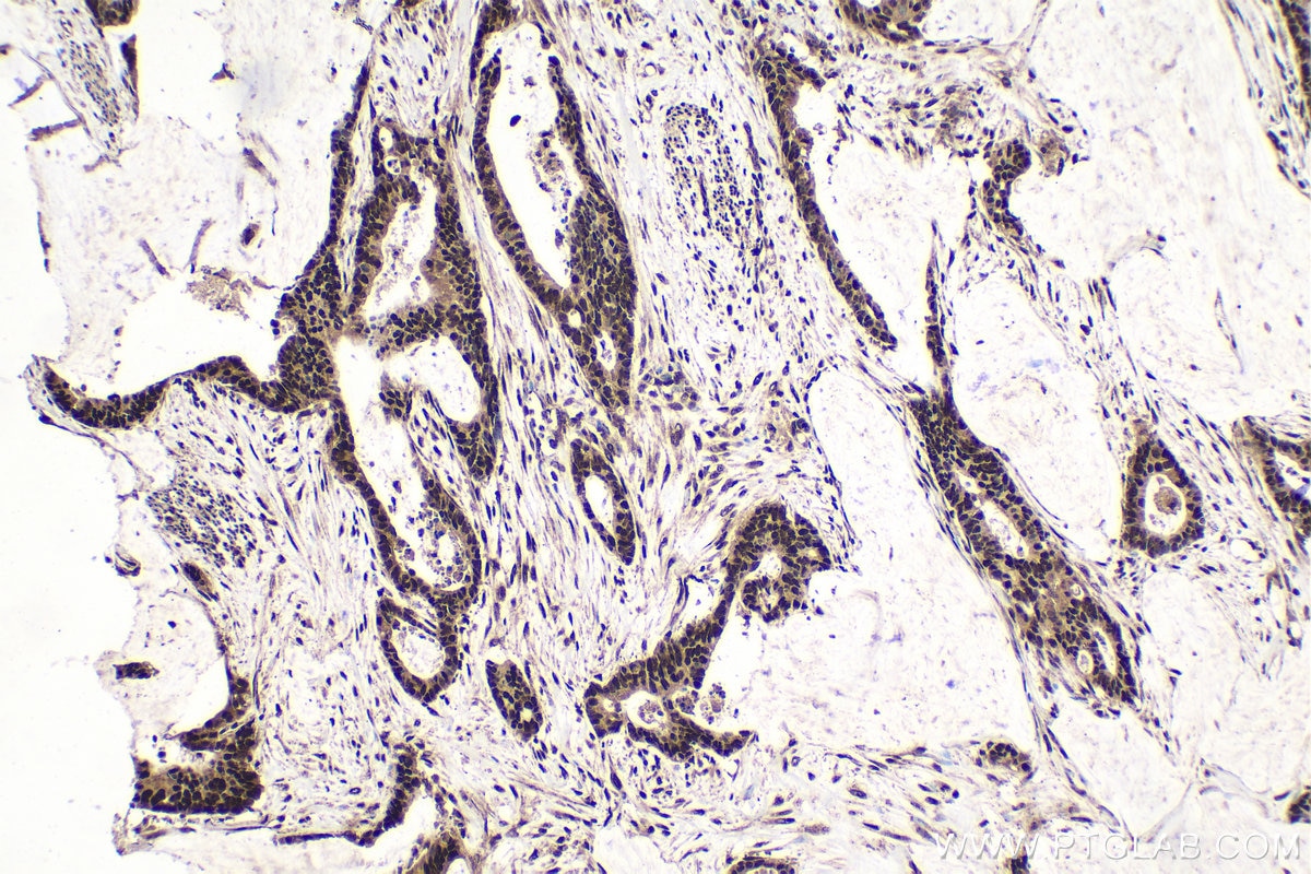 Immunohistochemical analysis of paraffin-embedded human urothelial carcinoma tissue slide using KHC1575 (RXRB IHC Kit).