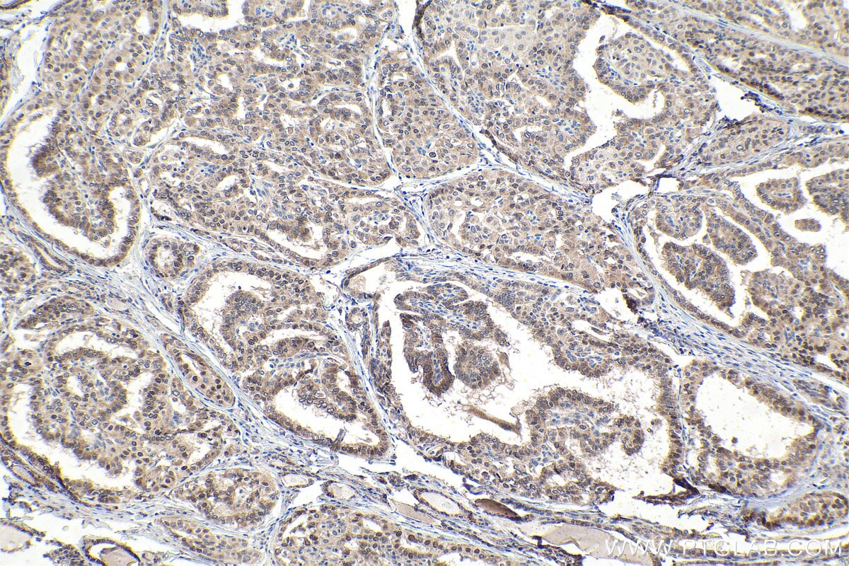 Immunohistochemical analysis of paraffin-embedded human thyroid cancer tissue slide using KHC1611 (RXRG IHC Kit).